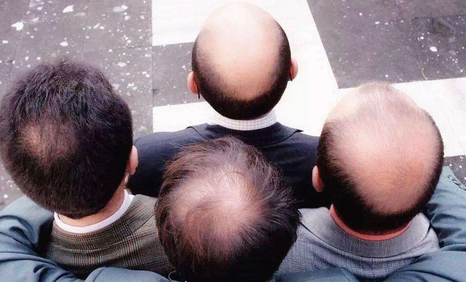 职场健康课脱发_脱发健康宣教_脱发培训